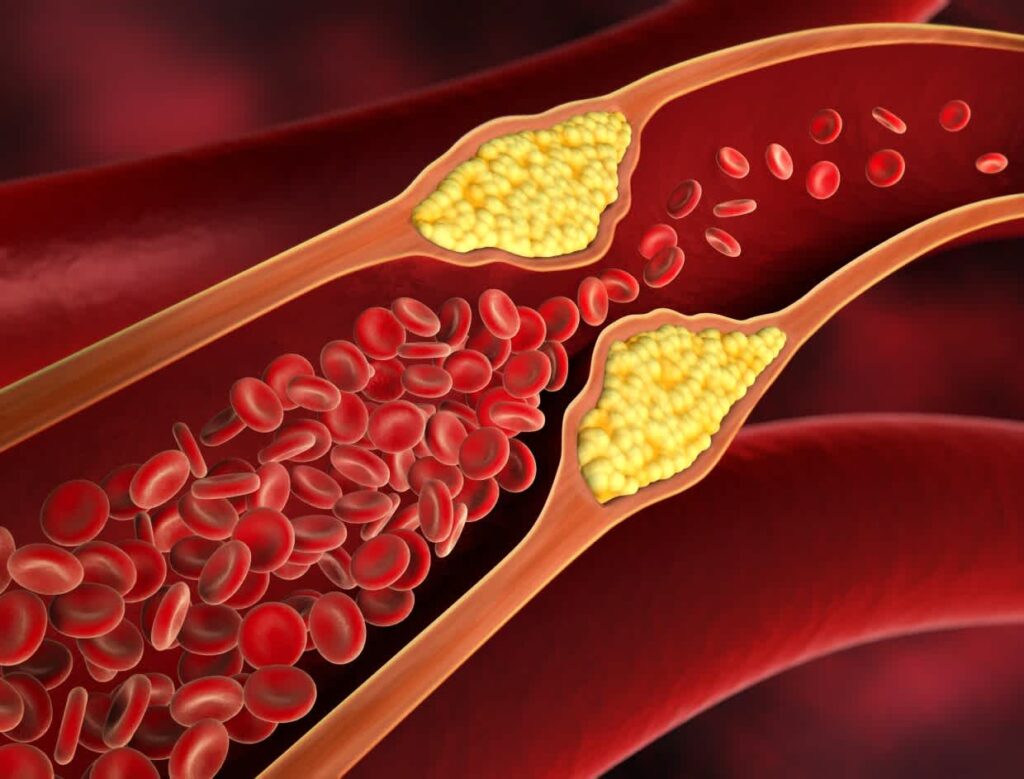 Read more about the article LDL Cholesterol: Understanding the Role, Risks, and Management